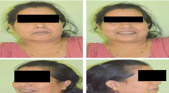 Figure 6: Two year after Deboning.