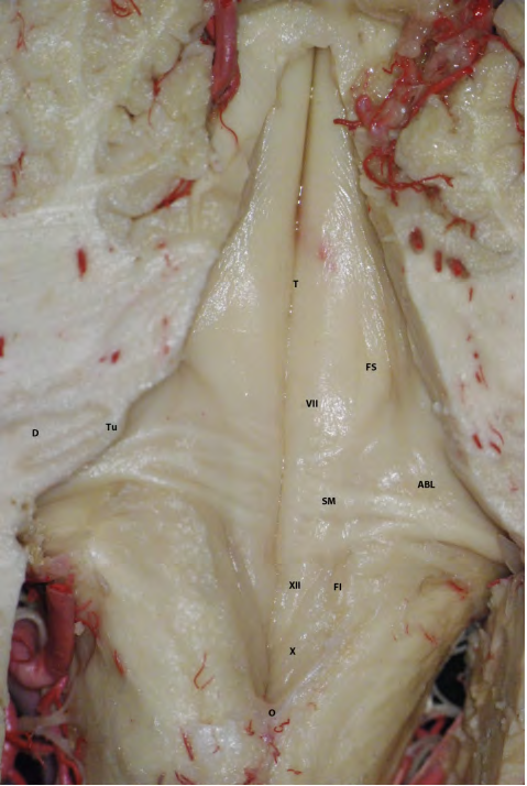 Figure 2: Floor of the IV Ventricle. T: Posterior Longitudinal Groove; FS: Upper Fossa; VII: Facial Colliculus; SM: Stria Medullaris; ABL: Vestibular Area; XII: Trigone of the XII Nerv; X: Trigone of the Vagus; FI: Lower Fossa; Or: Obex Rhoton A, Peris-Celda M, Martínez Soriano F. Rhoton - Atlas of the Head, Neck and Brain.