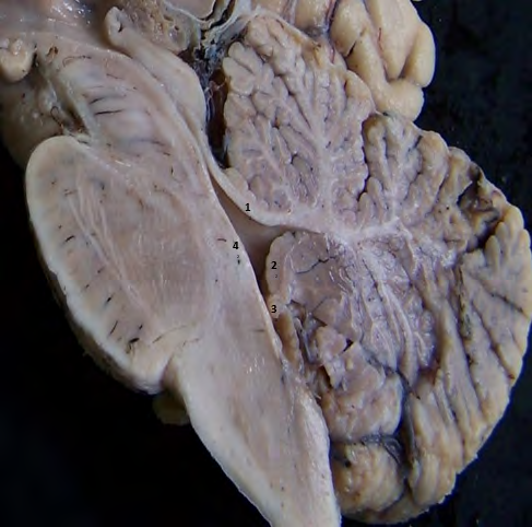Figure 4: Sagittal Section of the Brainstem. 1: Superior Medullary Velum; 2: Inferior Medullary Velum; 3: Tela Choroidea; 4: Floor of the IV Ventricle.