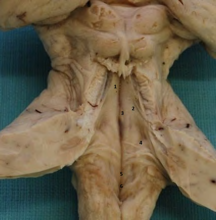 Figure 5: Floor of the IV Ventricle 1: Posterior Longitudinal Groove; 2: Sulcus Limitans; 3: Facial Colliculus; 4: Vestibular Area; 5: Hypoglossal Trigone; 6: Vagus Trigone.