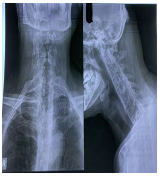 Figure 2: Solid ankylosis of the facet joints between the second and fifth vertebrae.