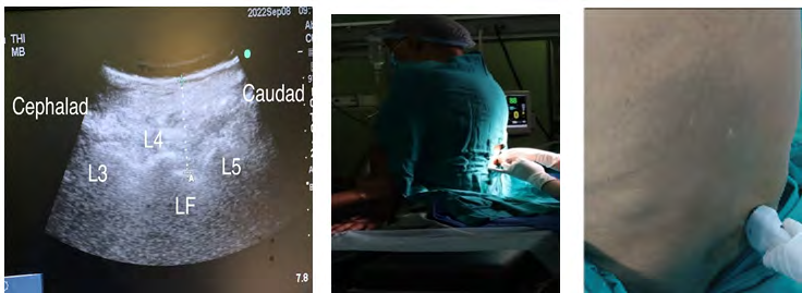 Figure 3: Longitudinal parasagittal lumbar scan of spine.