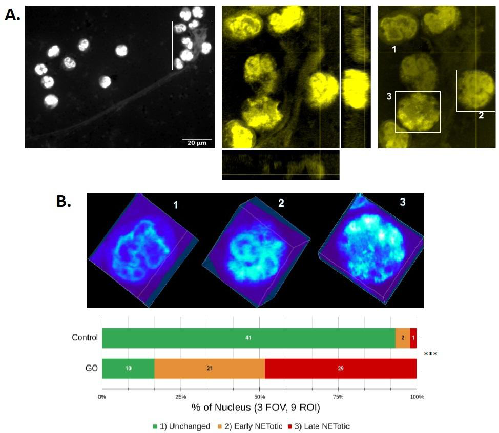 Figure 4: Analysis of NETosis stages in PMNs stained with Pyronin Y. A. Morphological analysis of PMNs incubated with glucose oxidase (GO) for 150 minutes, fixed with PFA (2%), labeled with Pyronin Y, and microphotographed and analyzed as described in Figure 3B. A region of interest (ROI) from a representative experiment (n=4) is presented on the right. To highlight the presence of NETs, the contrast was digitally intensified in the photograph on the left. Below and to the right of this image are orthogonal z-x and z-y projections of two planes centered on a protrusion of a NET. In the delimited rectangular areas in the image on the right, three examples of nuclei with different degrees of alteration in response to GO treatment are shown: 1) a nucleus without apparent changes, 2) a nucleus with altered lobular morphology and increased decondensation of chromatin (greater dye incorporation), and 3) a nucleus with total loss of lobular morphology, decondensation of chromatin, and/or spillage of genetic material into the extracellular medium. B. The upper image shows a volumetric projection of a heat map of the fluorescence intensity distribution in the boxed spaces in A. Below, the data obtained from three fields of observation (FOV) taken at random are summarized, with three ROIs chosen per FOV (approximate volume = 30x40x10 µm), accounting for nine ROIs per treatment (18 ROIs per experiment with approximately three nuclei each). *** p<0.001; Chi-squared test for trends. The results presented correspond to one independent experiment representative of four carried out.