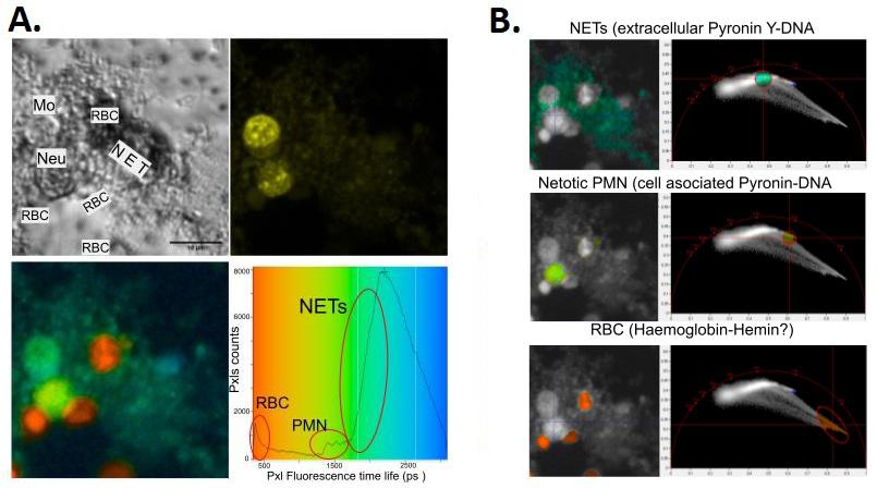 Figure 7: NETosis studies using the FLIM technique in Pyronin Y-stained human leukocytes. A. Fluorescence lifetime analysis (FLIM) in PMN peripheral human neutrophils stimulated for 2.5h with GO to induce NETosis. Once the culture was complete, the cells were fixed (PFA 2%) and stained with Pyronin Y. Mo: monocyte; RBC: red blood cell; Neu: Neutophil; NET: Extruded chromatin from NETotic cells. B. Time domain Phasor plot analysis lets us differentiate between NETs, NETotic cell nuclei, red blood cells and “viable”(live just before chemical fix) cells (Mo).