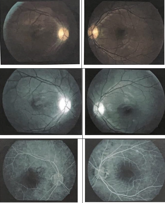 Figure 2: Fluoracein angiography in both eyes.