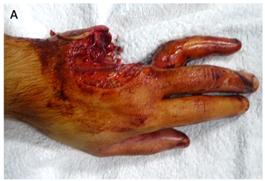 Figure 1: A,B: Preoperative images of the hand, C,D: intraoperative images of the hand after the reconstruction of bones and tendons and achieving the replantation.