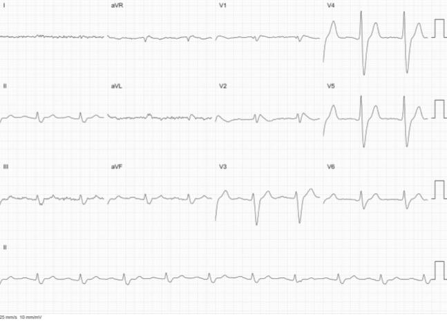 Figure 2: During Infusion.