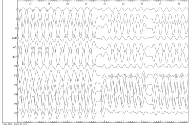 Figure 3: Polymorphic Ventricular Tachycardia.