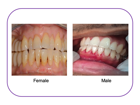 Figure 1: Feature of periodontitis.