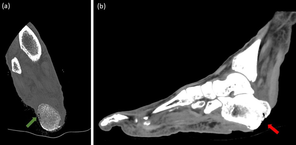 Figure 2: CT scan of the right ankle axial (a) and sagittal (b) plane. Subcortical air in calcaneal tuberosity; representing osteonecrosis (green arrow). Loss of overlying soft tissue in the posterior aspect of calcaneal tuberosity (red arrow).