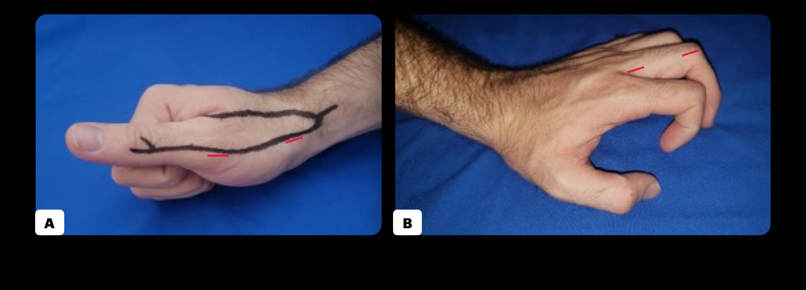 Figure 1: Minimal incision approach.