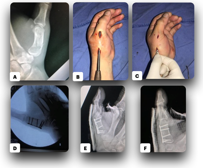 Figure 2: ** Thumb metacarpal fracture reduction and fixation in young male.
