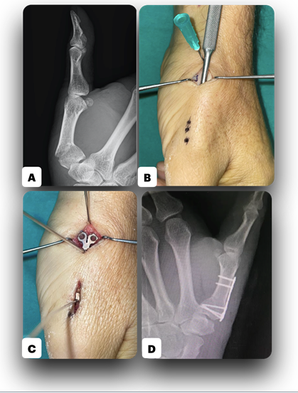 Figure 5: ** Thumb metacarpal fracture reduction and fixation.