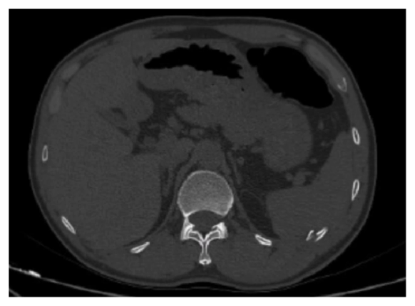 Figure 2: Chest CT on admission suggested a left rib fracture.