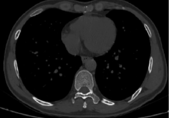 Figure 3: Chest CT on admission suggested no septal muscle damage diameter signs and pleural effusion in the left chest.