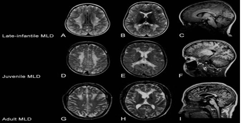 Figure 9: Metachromatic Leukodystrophy.