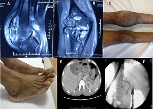Figure 1: A & B) MRI of knee joints showing joint effusion, soft tissue swelling and inflammation along with erosion in articular surface, joint deformity with Bone marrow edema. C) Left knee joint synovitis with effusion. D) Right ankle joint synovitis. E) CT abdomen showing- Atrophic pancreas with dilated main pancreatic duct (MPD), mild peri-pancreatic fluid with thrombosis of segmental branches of left portal vein. F) Fluoroscopic image showed pancreatic head short stricture with mildly dilated and irregular main pancreatic duct.