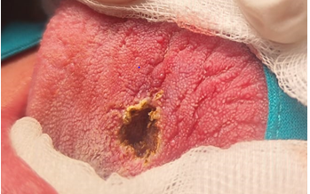 Figure 1: Nodular Lesion on the Dorsal Medial Side of the Tongue.