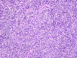 Figure 2: Endometrial stromal sarcoma exemplifying spherical cells pervaded with eosinophilic cytoplasm and atypical nuclei. Surrounding stroma is fibromyxoid and imbued with vascular articulations. Mitotic figures are observed [7].