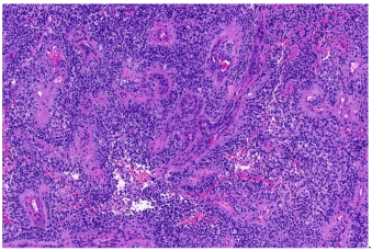 Figure 2: EWSR1::SMAD3 fibroblastic tumours demonstrating a nodular neoplasm composed of hyalinised centric area circumscribed by peripheral fascicles of uniform spindle shaped cells lacking pleomorphism or atypia [7].