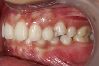 Figure 11: Left Lateral View (In Occlusion).