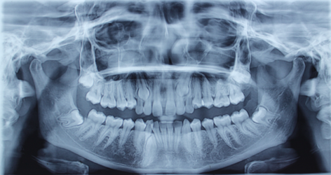 Figure 13: Pre- Treatment OPG.