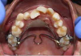 Figure 4: Front View at Rest and Smile.