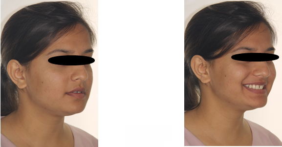 Figure 6: Oblique View at Rest and Smile.
