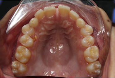 Figure 7: Maxillary Occlusal View.