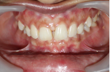 Figure 8: Front View in Occlusion.