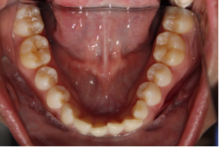 Figure 9: Mandibular occlusal view.