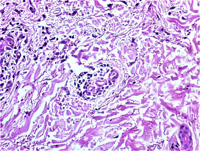 Figure 2: Blood vessels in the mid-dermis are showing endothelial cell swelling, extravasation of red cells, perivascular lymphocytes and nuclear dust (Hematoxylin- eosin, x400).