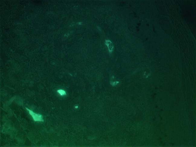 Figure 4: IgA deposits in the walls of blood vessels (Direct immunofluorescence, x400).