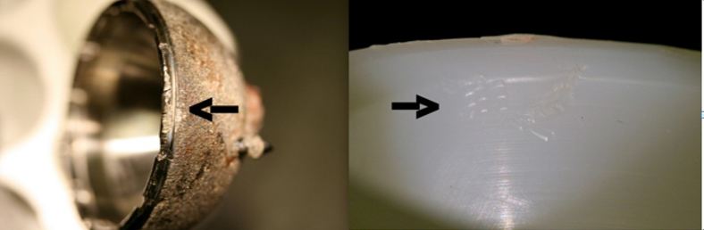Figure 1: Picture of the retrieved un-cemented titanium hemispheric acetabular shell (side view), and polyethylene liner implant with abrasion marks (arrow), indicating the site of impingement.