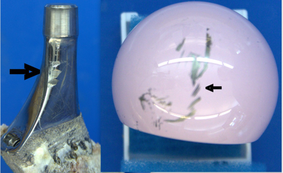 Figure 2: Picture of the retrieved un-cemented femoral stem with impingement marks and the ceramic femoral head with evidence of stripe wear.