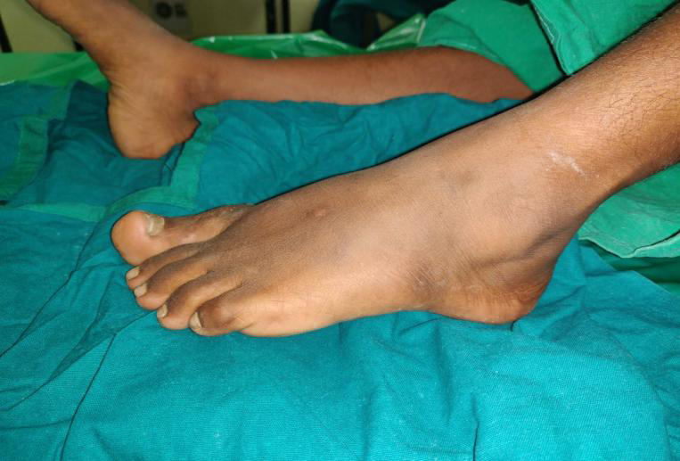 Figure 1: Macrodactyly left big toe.