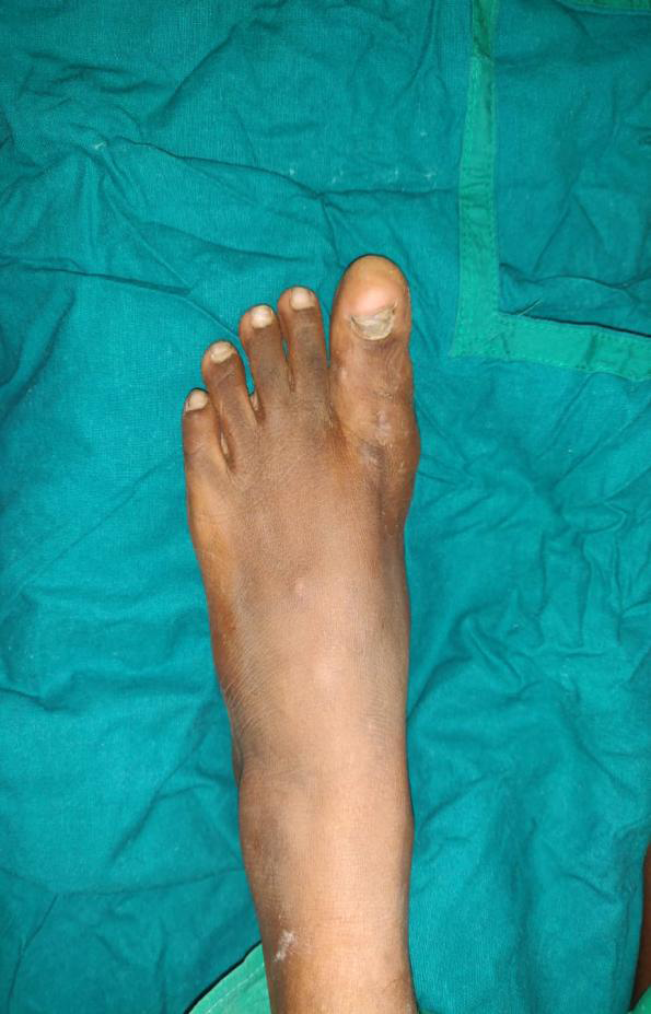 Figure 3: Post low level laser therapy reduction in size.