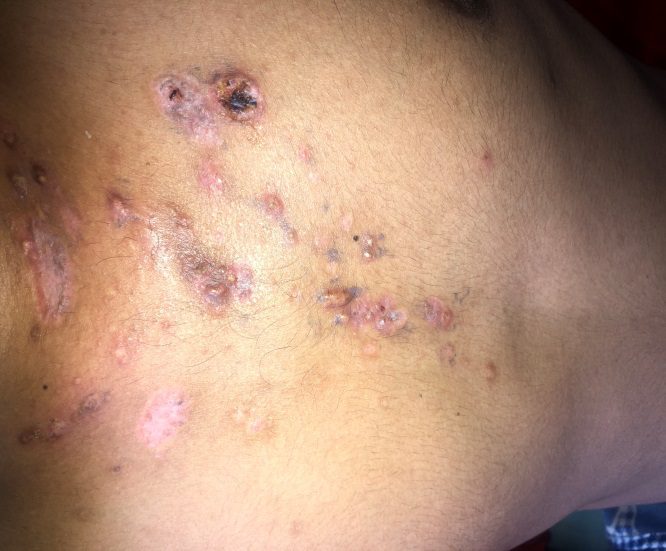 Figure 1: Comedones, papules and pustules on the chest of a 23 year old male.