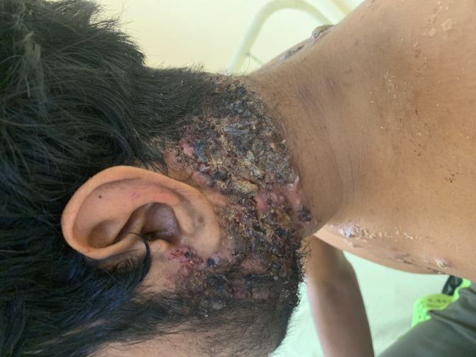 Figure 2: Ulcer with adherent crusting on the neck.