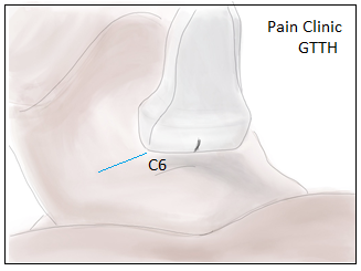 Figure 2: This study employs ultrasound imaging probe- placement play a critical role in the successful execu- tion of an ultrasound-guided stellate ganglion block.