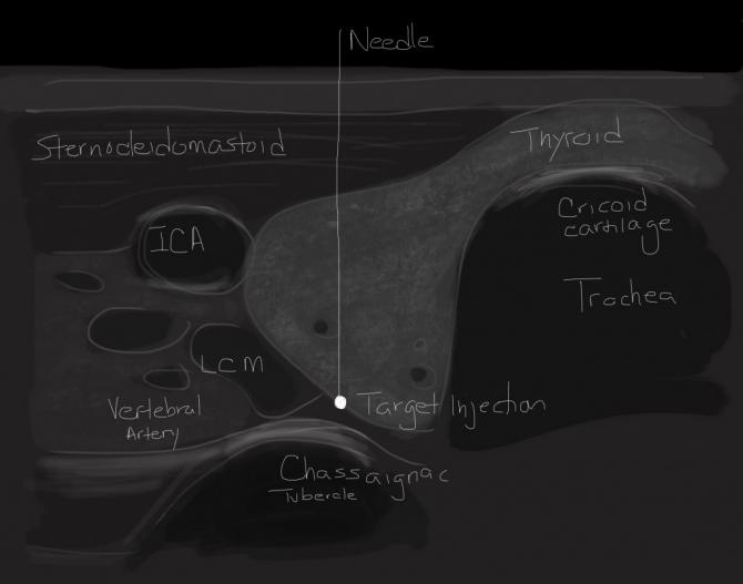 Figure 3: This study employs ultrasound imaging to visualize internal structures and needle placement for the purpose of performing an ultrasound-guided stellate ganglion block.