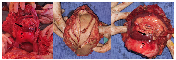 Figure 2: Intraoperative images of the resected mass and after resection. (Arrowhead : bladder dome ; Arrow : bowel loop) Histological examination revealed oval basophilic intracellular and extracellular inclusions corresponding to Michaelis-Gutmann bodies. The diagnosis of malakoplakia was confirmed (Figure 3).