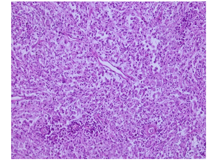 Figure 3: Histological examination revealing oval basophilic intracellular and extracellular inclusions corresponding to Michaelis-Gutmann bodies.