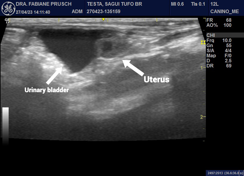 Figure 2: Left white arrow showing the urinary bladder and the right white arrow showing the uterus at the abdominal ultrasound.