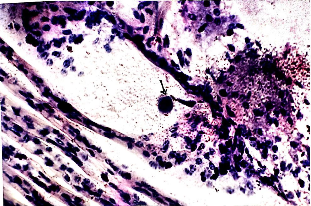 Figure 10: Showing the multi-inclusion of hypertrophic basophilic intranuclear inclusion bodies by MBV in Macrobrachium rosenbergii.