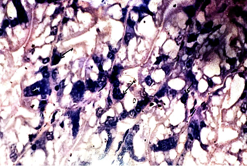 Figure 8: Showing the hypertrophic nuclear occlusion body in the hepatopancreatic secretary cells of infected prawn, Macrobrachium rosenbergii.