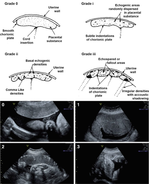 Figure 4: Ultrasound Images depicting the major stages of placental development. Source: Branco AC, et al. Placental Calcification: Long-standing Questions and New Biomedical Research Directions. In: Aikawa E, (eds) Cardiovascular Calcification and Bone Mineralization. Contemporary Cardiology, Humana, Cham. https://doi. org/10.1007/978-3-030-46725-8_13 The placenta may be visualized as early as 6 weeks of gestation (4 weeks after fertilization) on transvaginal ultrasound when an intrauterine pregnancy may not yet be obvious on transabdominal scan. The image gotten for this procedure shows the chorionic cavity and the echogenic chorionic villi that are implanting. It also illustrates a yolk sac and an umbilical cord. In the beginning stages of the first trimester, the average diameter of the gestational sac increases approximately 1millimeters per day. Although, there’s an increased risk of embryonic death if the diameter of the gestational sac increases beyond 6millimeters from a normal range of 3 to 5millimeters [7,8]. By the end of the 5th week, the average diameter of the gestational sac grows from 16 to 23millimeters. An anembryonic pregnancy should be suspected if a transvaginal ultrasound does not detect an embryo at 16millimeters gestational sac size.