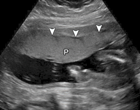 Figure 6: Ultrasound image showing a placenta that is uniformly homogenous in echo-texture. P stands for the placenta. Source: Imaging of the Placenta: A Multimodality Pictorial Review, Khaled M, et al. Radio Graphics 29:5, 1371-1391.