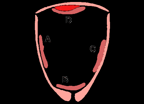 Figure 9: An ultrasound image representing the major pathologies of the placenta (A: normal placenta, B: Placenta previa, C: Placenta accreta, D: Abruptio placenta).