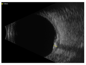Figure 3: B-scan ultrasound.